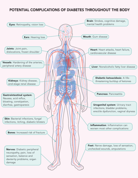 A Full-Body Disease: Complications That Can Accompany Diabetes